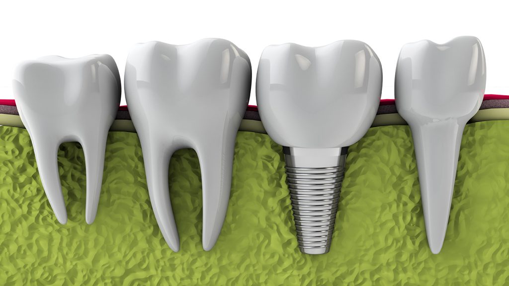 ایمپلنت فوری یا ایمپلنت یک روزه دندان چیست؟