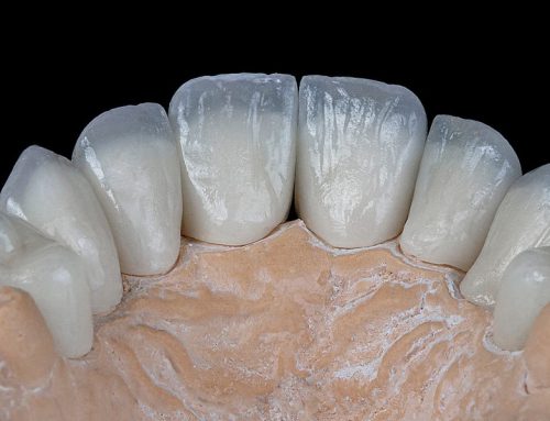 مراقبت از دندان روکش شده – بایدها و نبایدهایی که لازم است بدانید