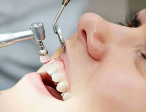 مراقبت بعد از جرمگیری دندان – بایدها و نبایدهای که باید بدانید