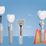بایدها و نبایدهایی از ایمپلنت دندان که باید بدانید