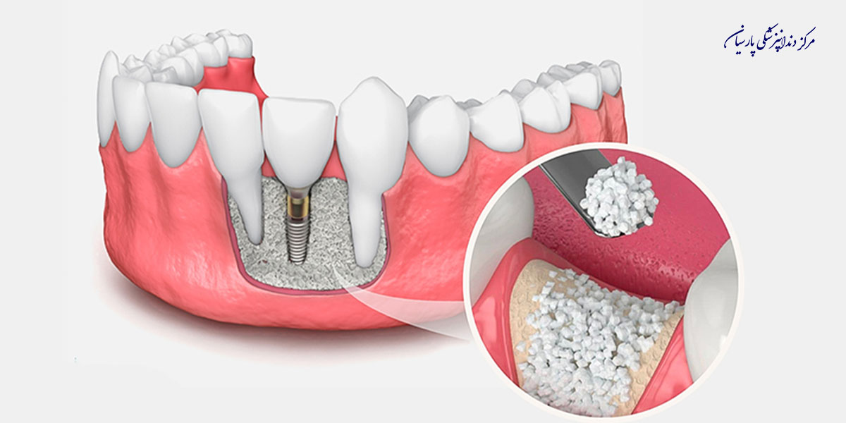 چه رابطه ای بین پوکی استخوان و ایمپلنت دندان وجود دارد ؟
