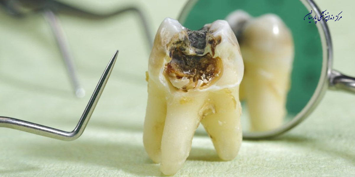 از نکروز دندان چه اطلاعاتی دارید ؟