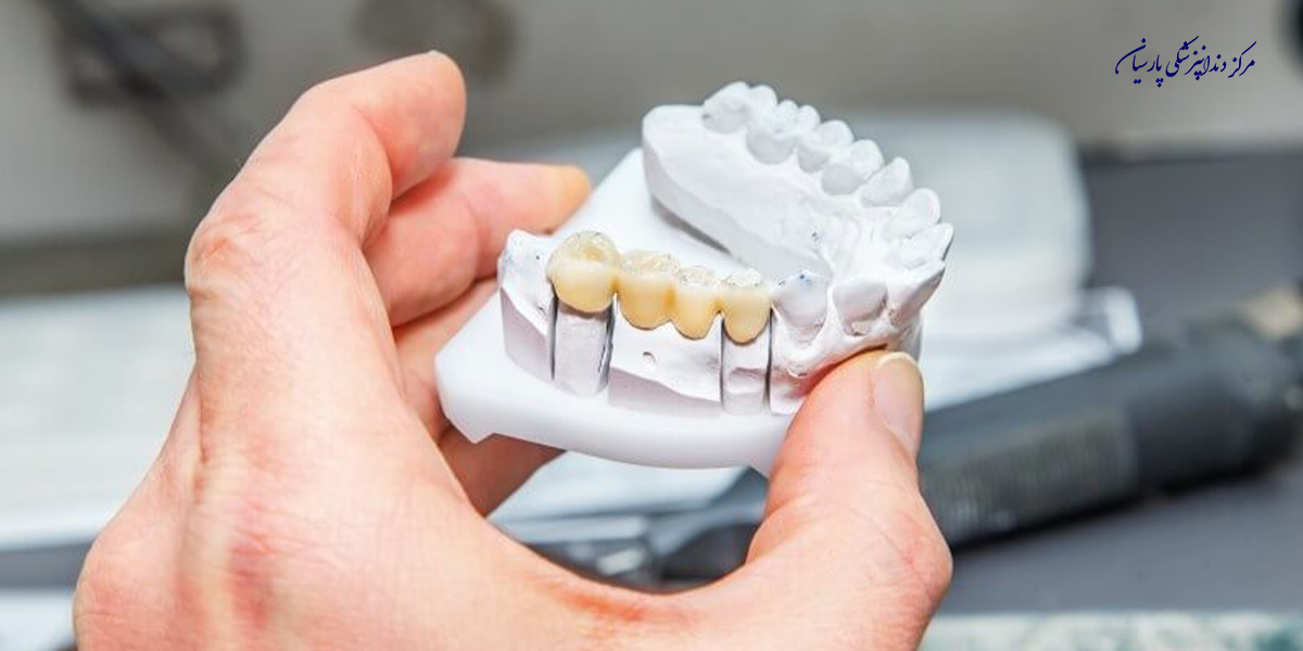 مزایا و معایب استفاده از بریج دندان چیست ؟