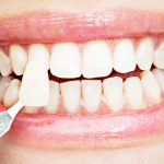 ویژگی های مهم چسب دندان که باید بدانید