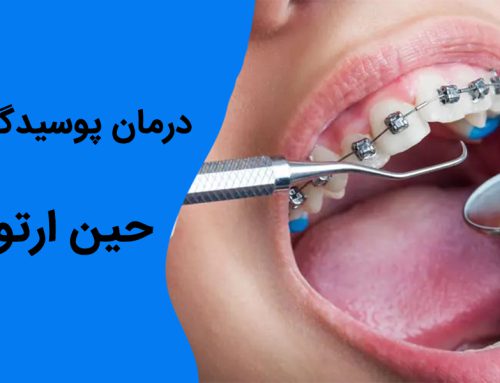 آیا درمانی برای پوسیدگی دندان حین ارتودنسی وجود دارد ؟