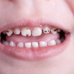 بایدها و نبایدهای از لمینت دندان کودکان که لازم است از آن اطلاع داشته باشید