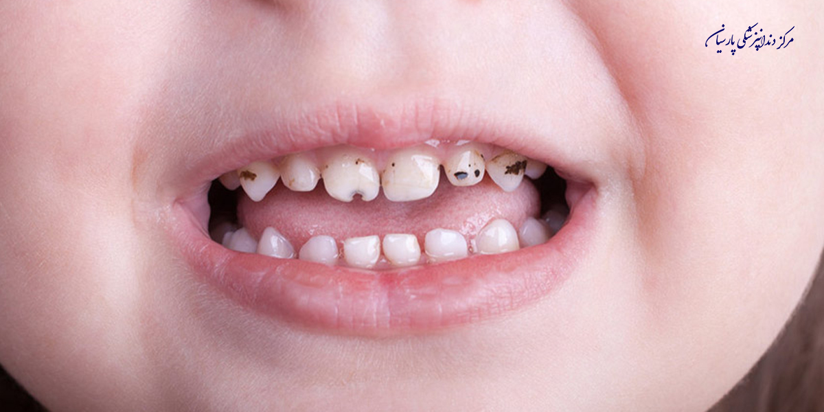 بایدها و نبایدهای از لمینت دندان کودکان که لازم است از آن اطلاع داشته باشید