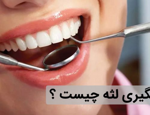 جرمگیری لثه چه تاثیری در سلامت دهان و دندان ها دارد ؟