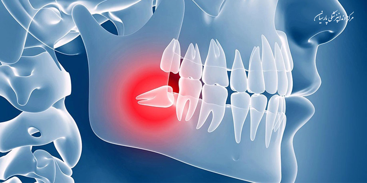 اگر دندانپزشک توصیه کرده دندان عقل نهفته خود را بکشید، نگران نباشید زیرا این دندان‌ها تاثیری در زیبایی و راحت‌تر جویدن غذا ندارد. بنابراین بهتر است برای جلوگیری از عفونت و آسیب به دندان‌های مجاور در اسرع وقت برای کشیدن آن اقدام کنید. دندانپزشک عمومی می‌تواند دندان‌عقل نهفته را جراحی کند اما در صورتی که این دندان در فک پایین به سمت عصب یا در فک بالا به سمت سینوس رشد کرده باشد، باید توسط متخصص جراحی شود.