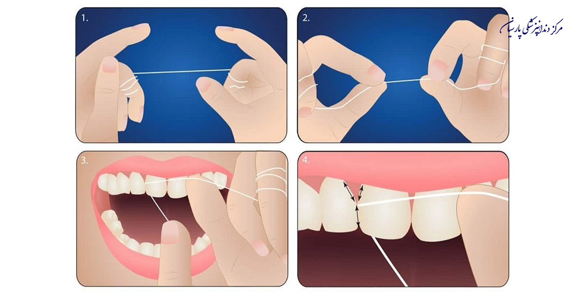 روش صحیح استفاده از نخ دندان چگونه است ؟